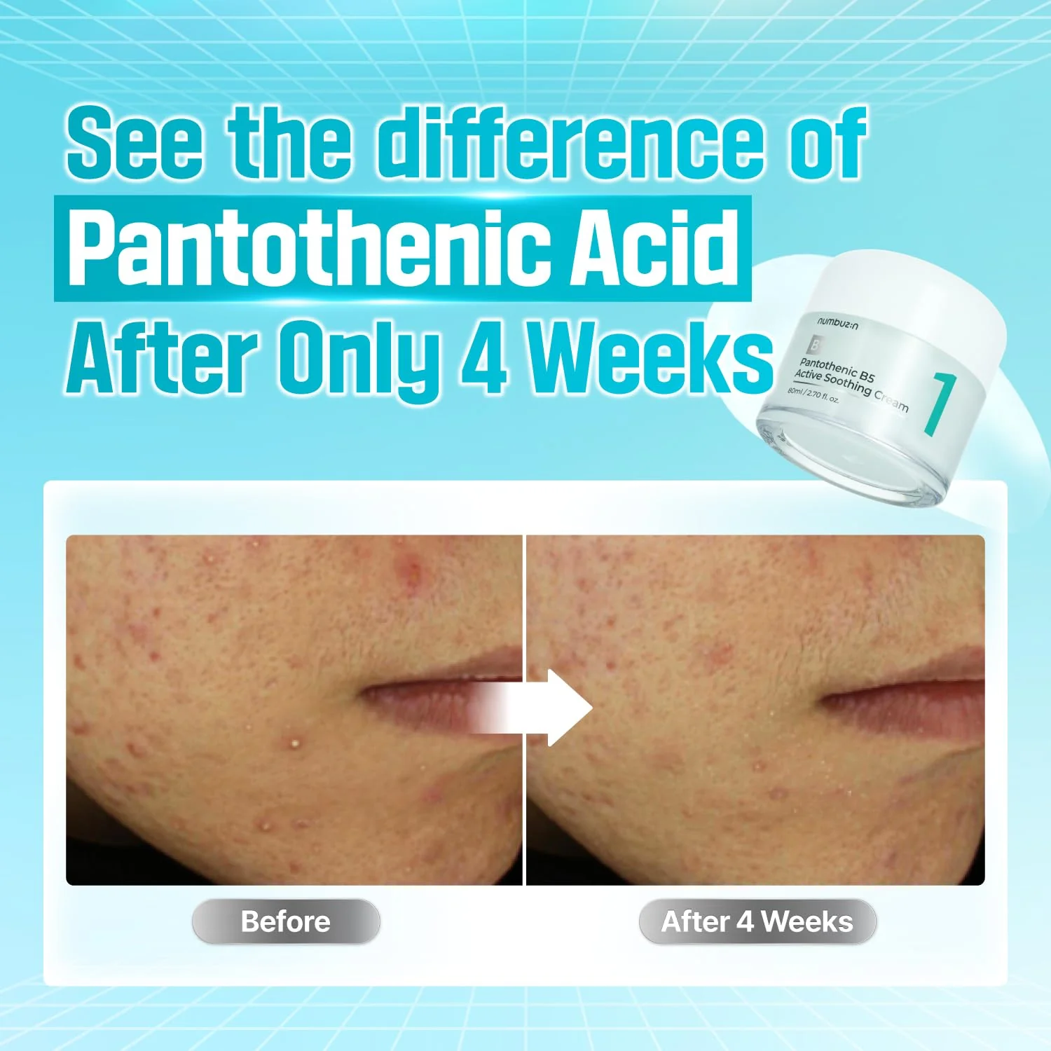 No.1 Breakout-Free Clear Skin Duo - Image 4