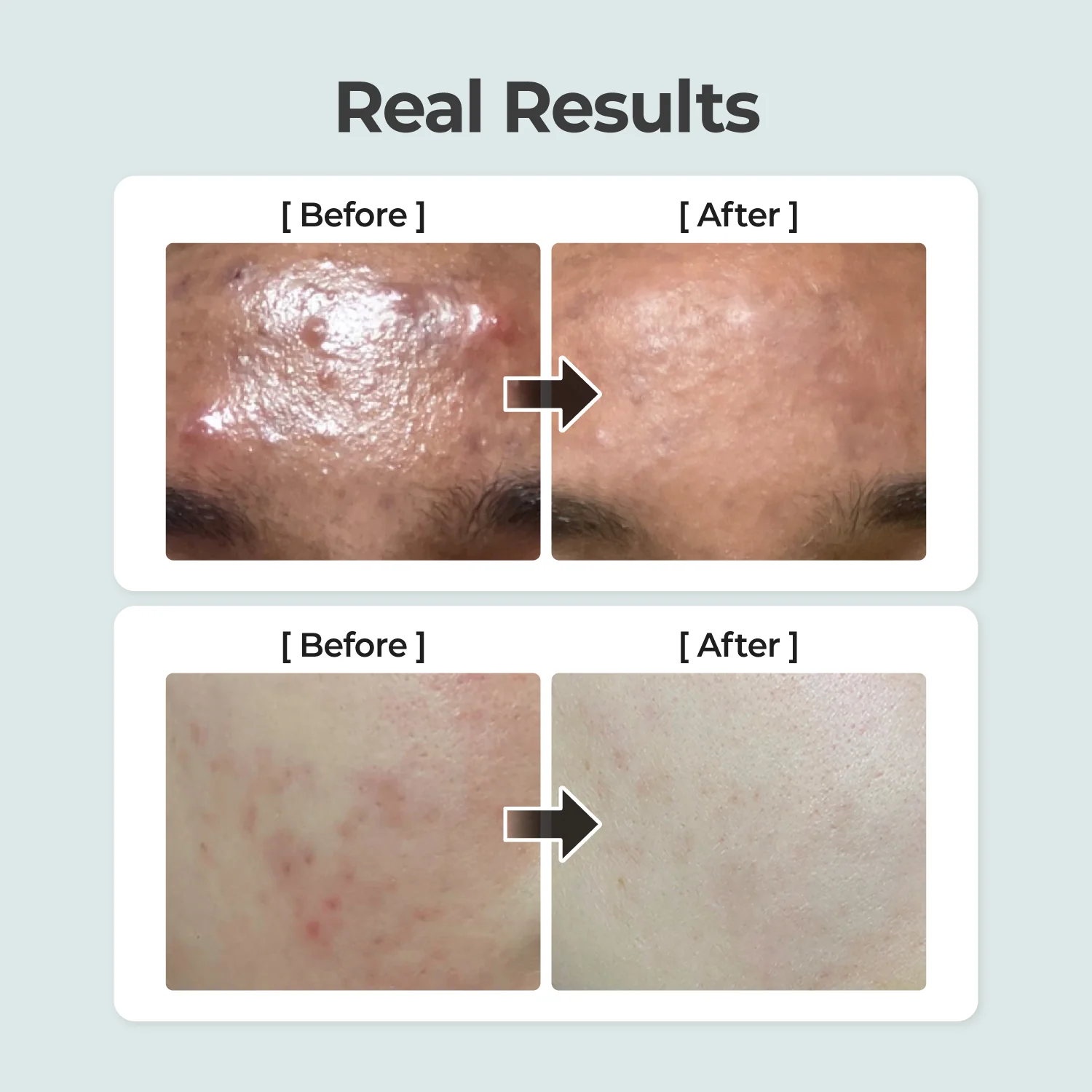 No.1 Breakout-Free Clear Skin Duo - Image 8